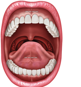 Illustration of the Frenectomy Procedure 